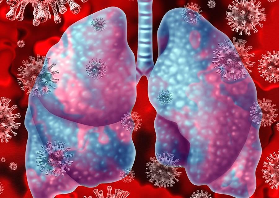 polmonite-virale-orig