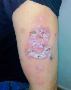 Il segno delle torture subite dai migranti per mano dei trafficanti in Macedonia. La vittima viene marchiata a fuoco con la lettera "S", iniziale del nome "Sultan" a capo della banda. (Foto di Livio Senigalliesi)